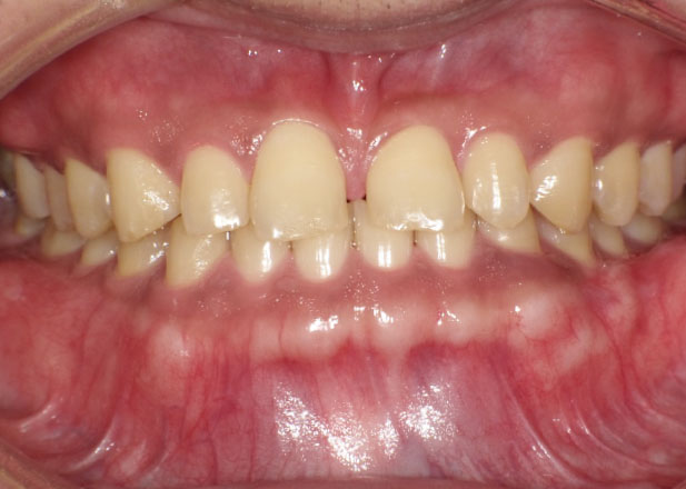 マウスピース矯正