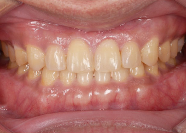 マウスピース矯正