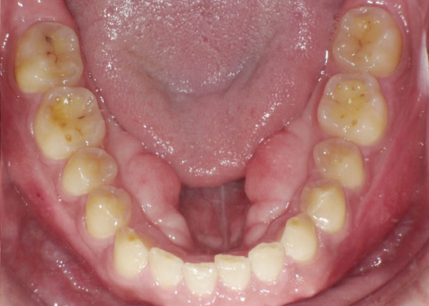 マウスピース矯正