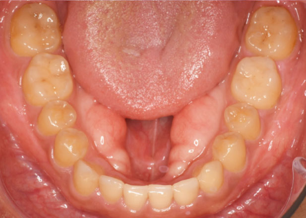 マウスピース矯正