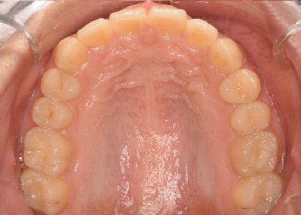 マウスピース矯正