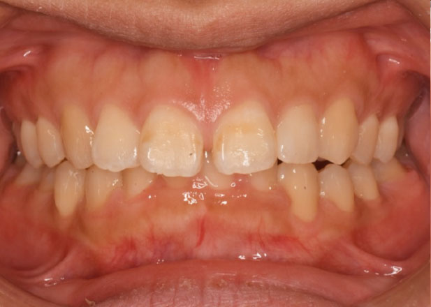 マウスピース矯正