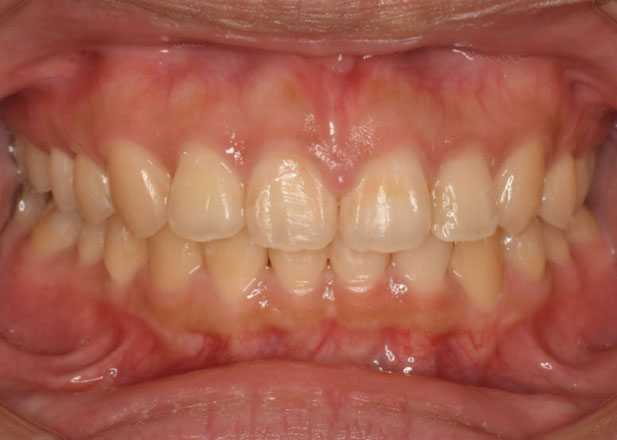 マウスピース矯正