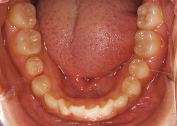 マウスピース矯正