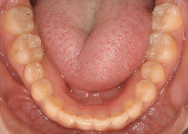 マウスピース矯正