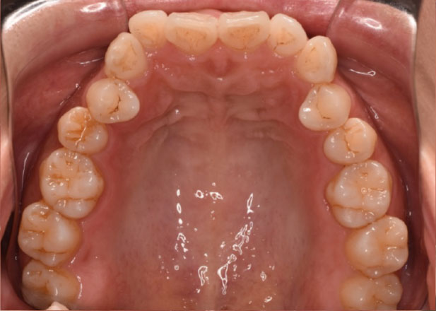 マウスピース矯正