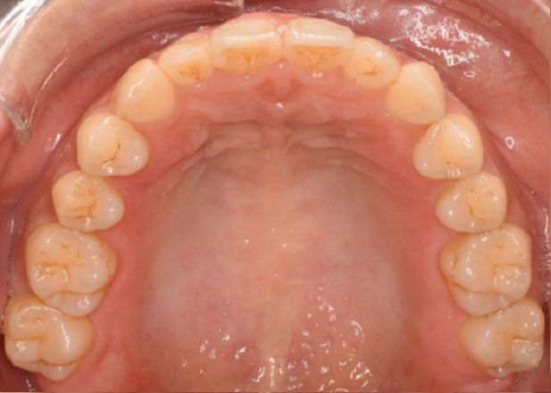 マウスピース矯正