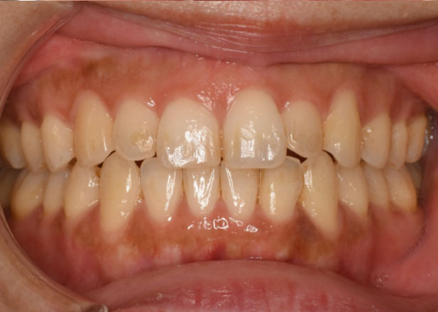 マウスピース矯正