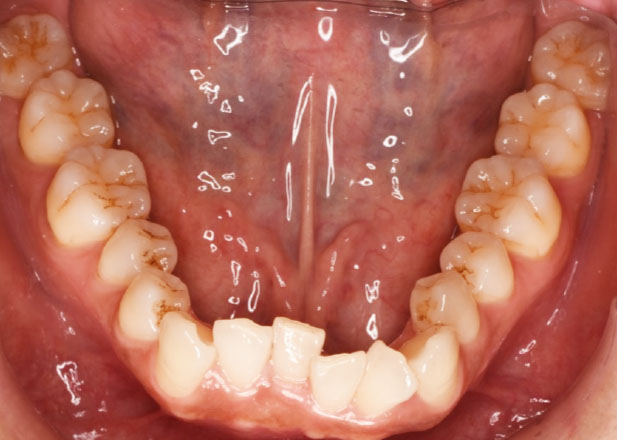 マウスピース矯正