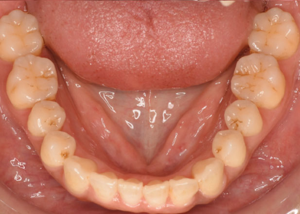 マウスピース矯正