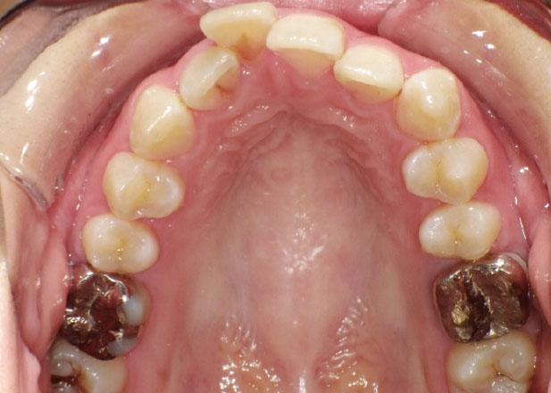 マウスピース矯正