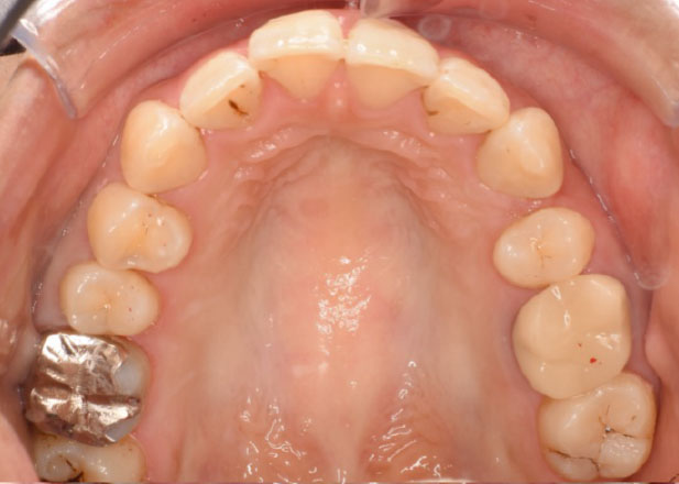 マウスピース矯正