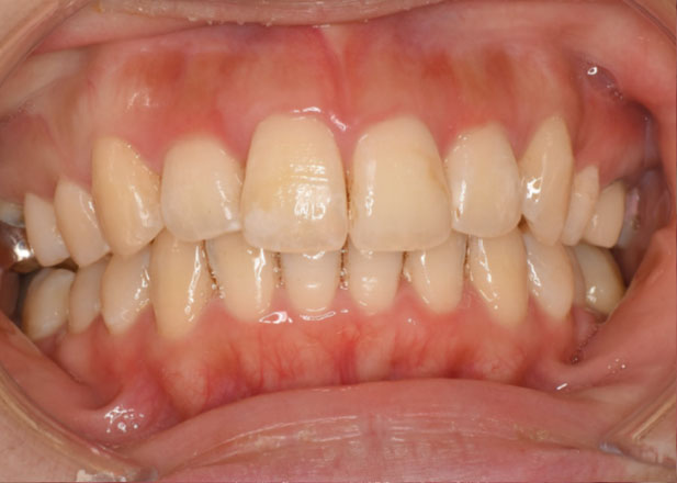 マウスピース矯正