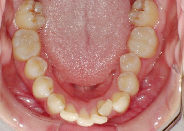 マウスピース矯正