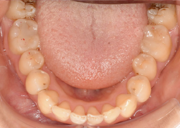 マウスピース矯正