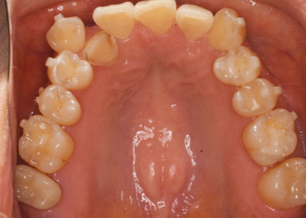 マウスピース矯正