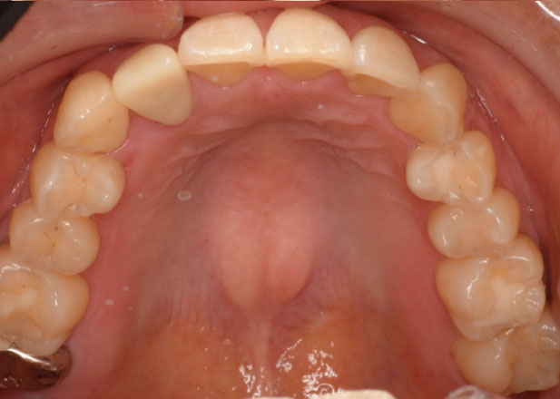 マウスピース矯正