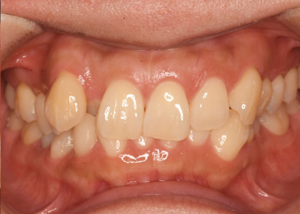 マウスピース矯正