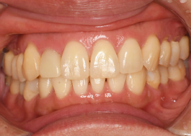 マウスピース矯正