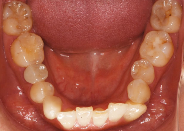 マウスピース矯正