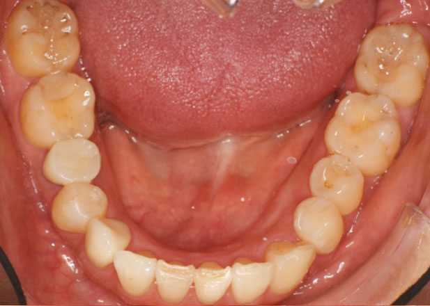 マウスピース矯正