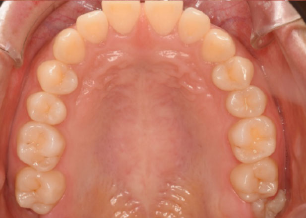 マウスピース矯正