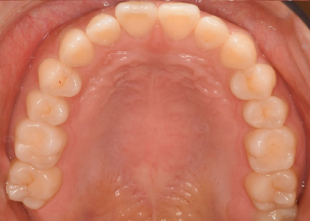 マウスピース矯正