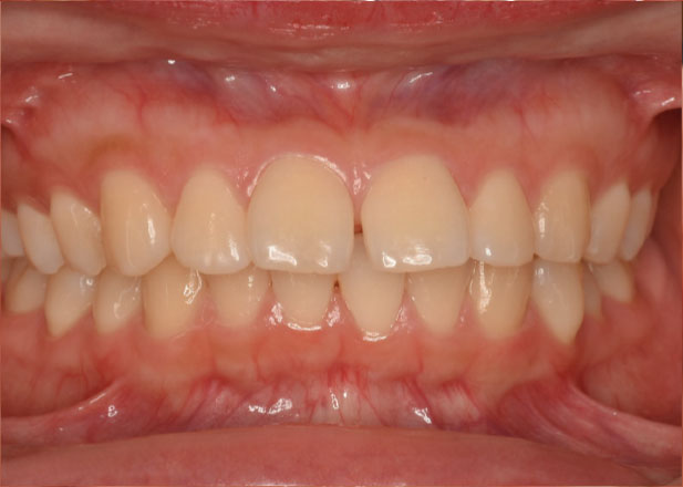 マウスピース矯正