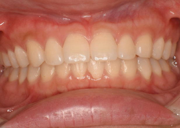 マウスピース矯正