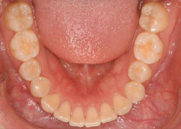 マウスピース矯正