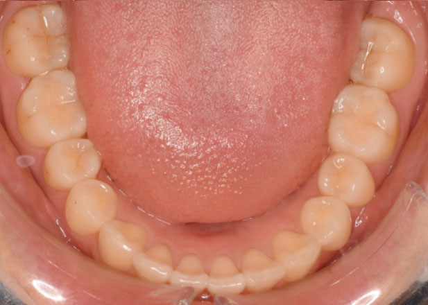 マウスピース矯正