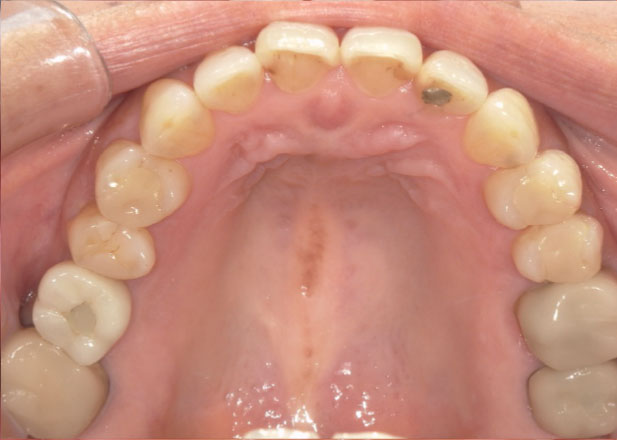 マウスピース矯正