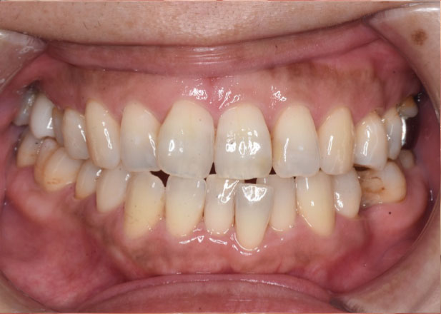 マウスピース矯正