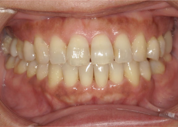 マウスピース矯正