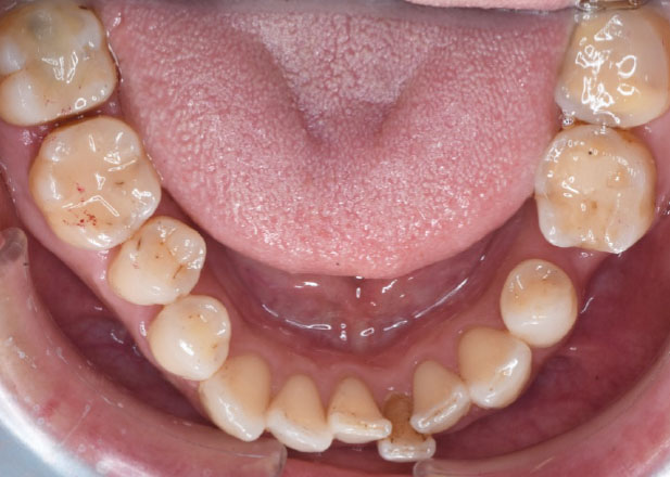 マウスピース矯正