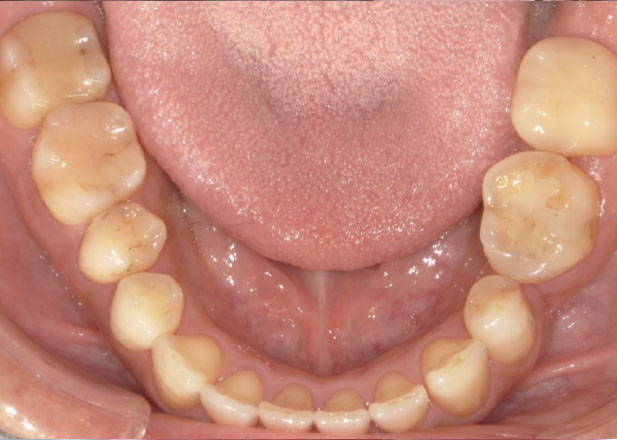 マウスピース矯正