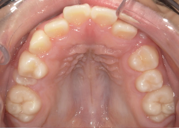 マウスピース矯正