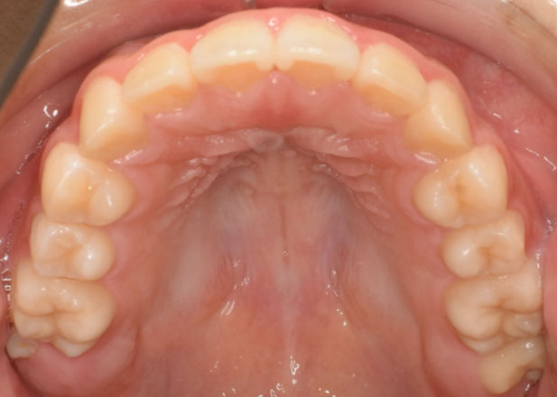 マウスピース矯正