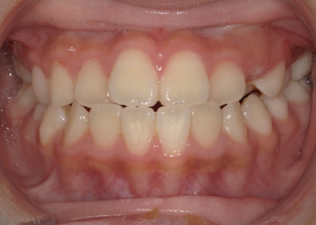 マウスピース矯正