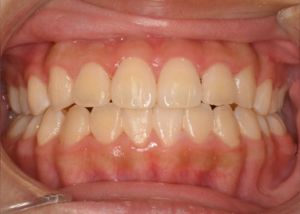 マウスピース矯正