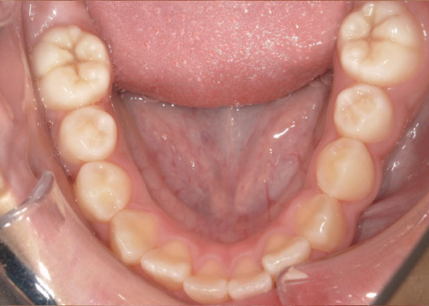 マウスピース矯正