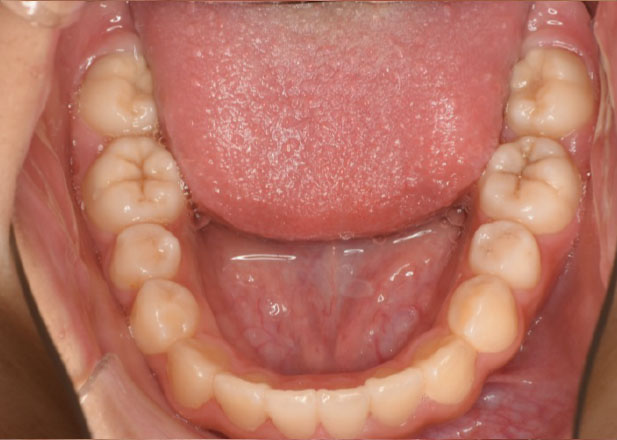 マウスピース矯正