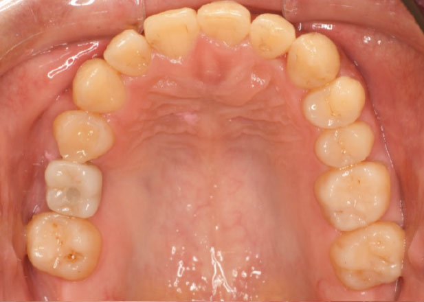 マウスピース矯正