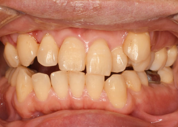 マウスピース矯正