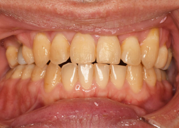 マウスピース矯正