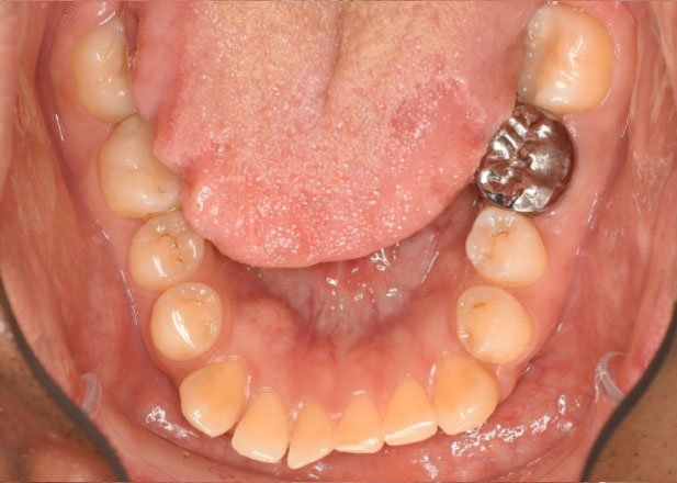 マウスピース矯正