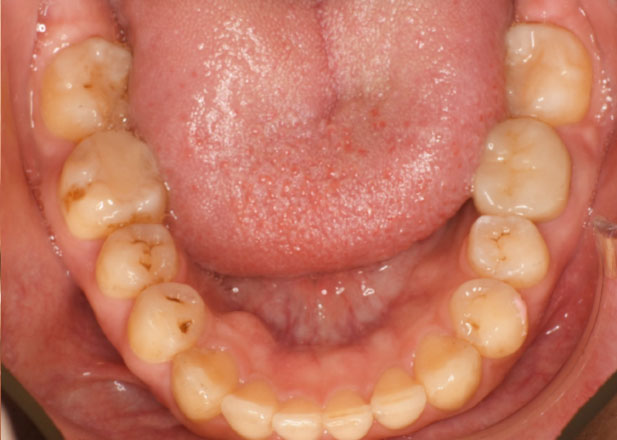 マウスピース矯正