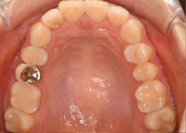 マウスピース矯正