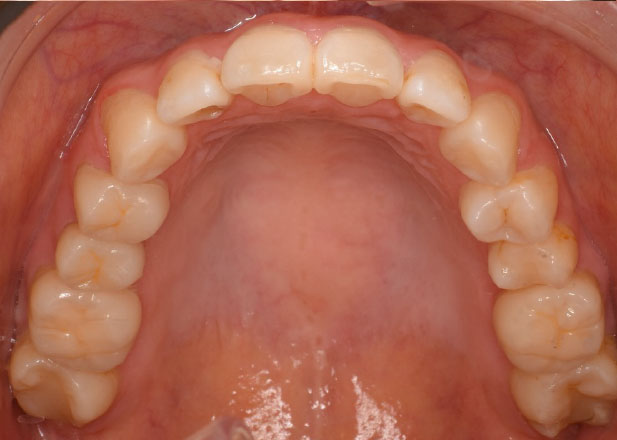 マウスピース矯正