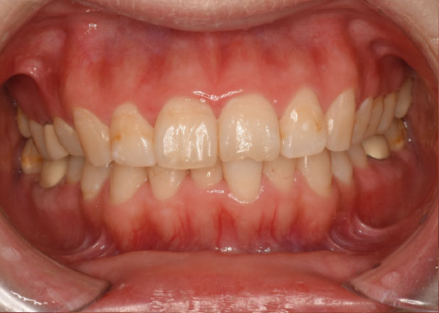 マウスピース矯正